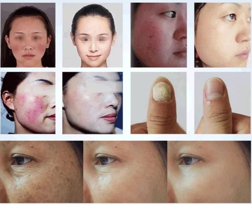 Schoonheidssalon 980nm diode laser machine voor pijnverlichting / vasculaire behandeling