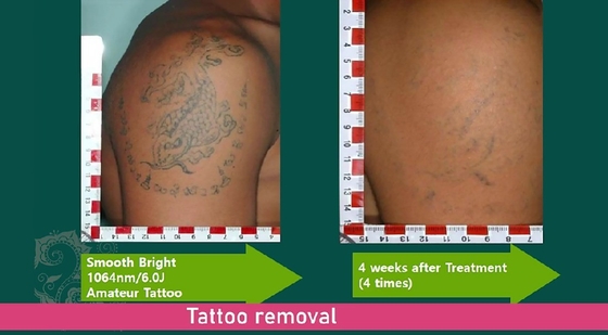 Picosecond laser gezichtsverjonging machine, Q Switched tatoeage verwijdering machine