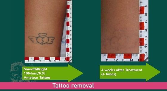 Commerciële Q Switched Laser Tattoo Removal Machine 1064nm 532nm 755nm