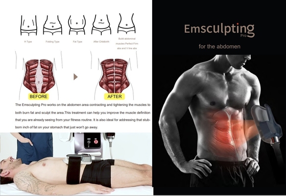 Geavanceerde EMS afslankingsmachine 150HZ Frequentie Voor Cellulitis Reductie