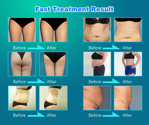 5 in 1 Vela Slimming Machine, Velashape Cellulite Reductie Machine voor Gezicht / Lichaam Contouring