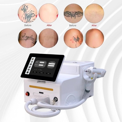 Laserbehandeling van nagels met laser 1064nm 532nm 1320nm