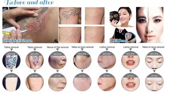 Draagbare Nd YAG Laser Tattoo Removal Machine 1064nm 532nm 1320nm golflengte