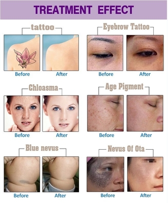 Long Pulse Nd YAG Laser Hair Removal Machine Draagbaar voor commerciële doeleinden