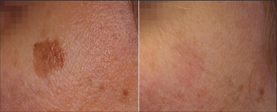 3 in 1 Q Switch ND Yag Laser Machine Tattoo Removal OEM ODM diensten