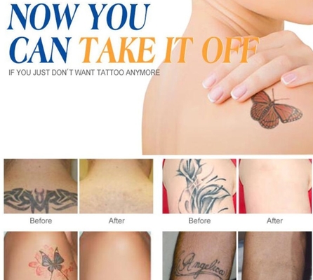 Custom Q Switch ND Yag Laser Machine voor tatoeage verwijdering / acne behandeling