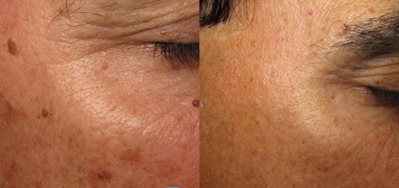 Custom Q Switch ND Yag Laser Machine voor tatoeage verwijdering / acne behandeling