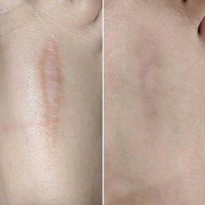 40w 60W Fractionele CO2 lasermachine voor het verwijderen van rimpels Stretch Mark Scar Removal Tightening