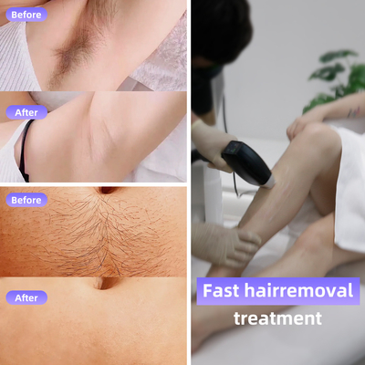 808 Diode Laser Ice Hair Removal Machine 4 golflengtes 1064nm Veranderbare vlekgrootte Android-systeem